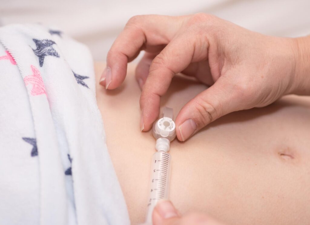 Gastrostomy